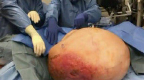 Asportato un tumore di 70 chili all'ospedale Molinette di Torino: “Pesava più della paziente stessa”