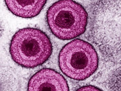 virus varicella